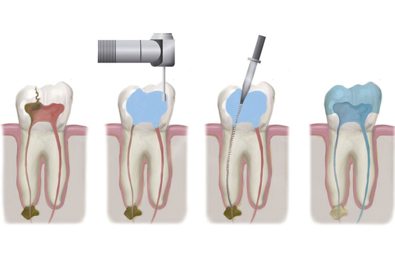 laser-root-canal-treatment