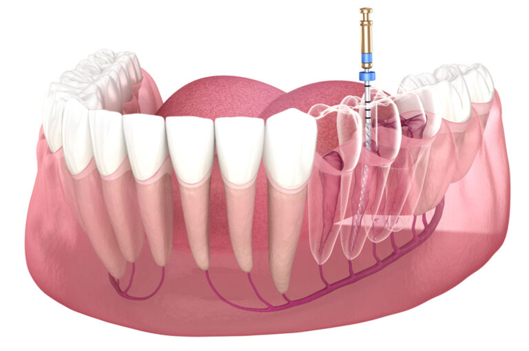 root-canal-treatment